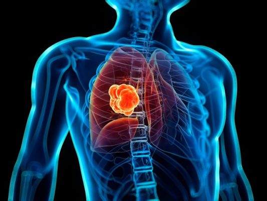 Các triệu chứng của khối u ác tính hiếm gặp trong phổi là gì?