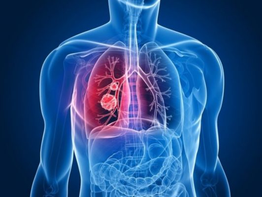 Các khối u ác tính hiếm gặp trong phổi gây ra như thế nào?