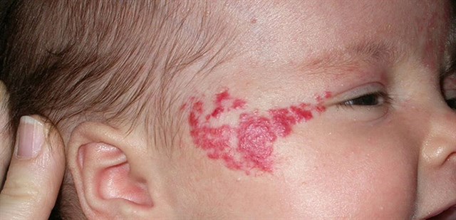 Các hạng mục kiểm tra đối với hội chứng u máu vùng đầu mặt là gì?