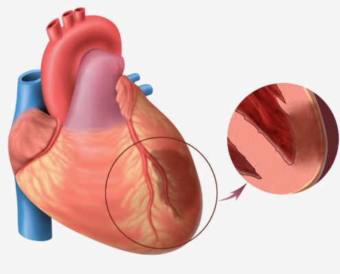 Chẩn đoán phân biệt với Khối u di căn ác tính ở tim như thế nào?