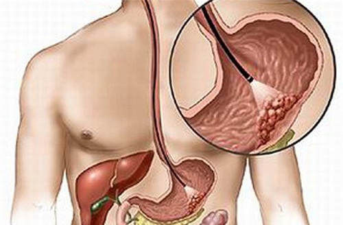 Nguyên nhân của khối u carcinoid dạ dày như thế nào?