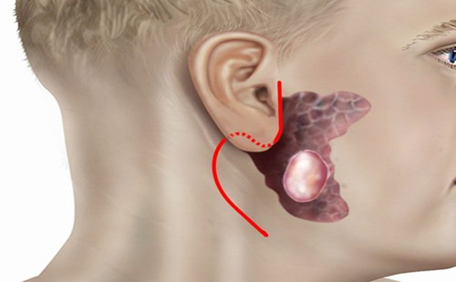 Các hạng mục giám định đối với khối u hỗn hợp tuyến mang tai là gì?
