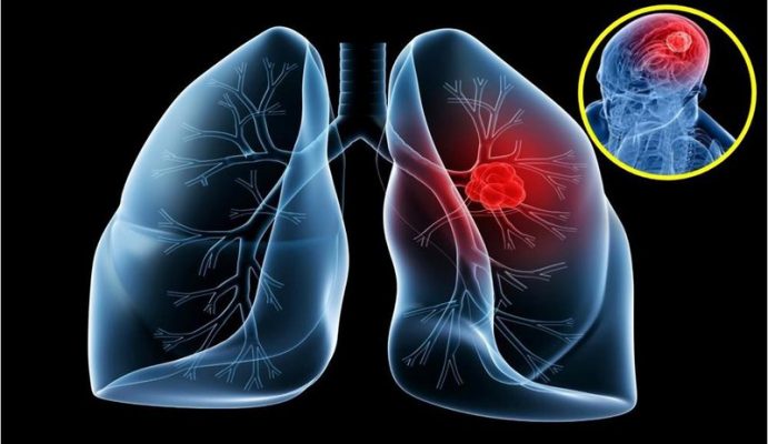 Các triệu chứng của khối u màng phổi di căn là gì?