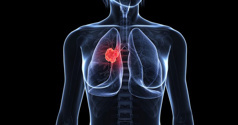 Các hạng mục của khối u màng phổi di căn là gì?