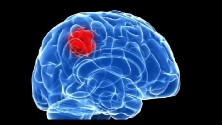 Các hạng mục giám định Khối u não là gì?
