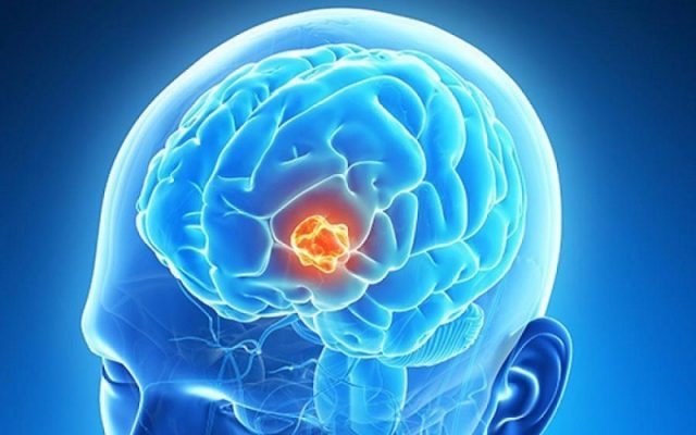 Làm thế nào để ngăn ngừa Khối u não?