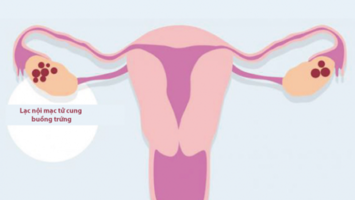 Khối u nội mạc tử cung buồng trứng có nguyên nhân như thế nào?