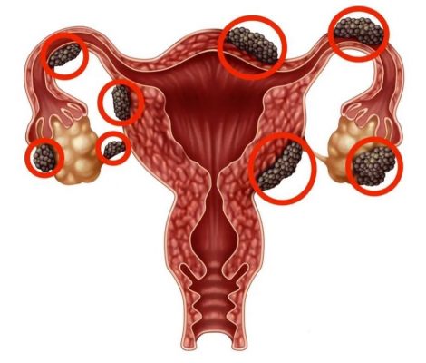 Làm thế nào để phân biệt và chẩn đoán u nội mạc tử cung buồng trứng?